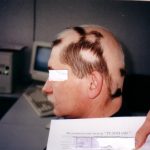 Лечение алопеции (облысения) и выпадения волос